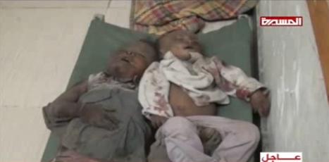 تصاویر هولناک از پیکر کودکان یمنی که در حملات وحشیانه عربستان به شهادت رسیدند