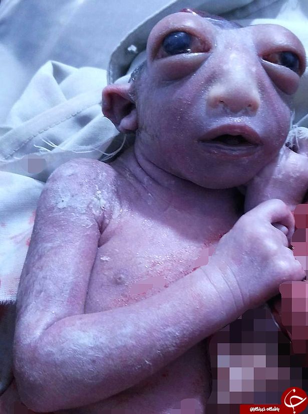 نوزادی که با یک نصفه سر بدنیا آمد+ عکس(18+)