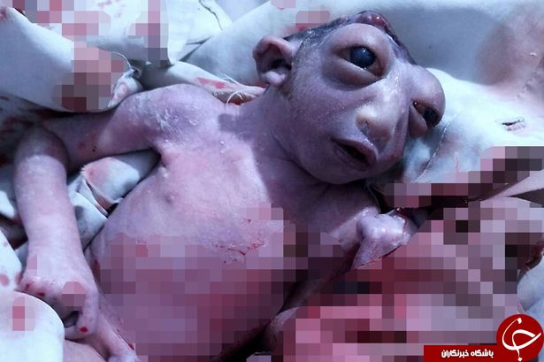نوزادی که با یک نصفه سر بدنیا آمد+ عکس(18+)