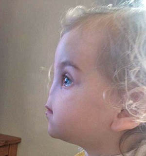 روشی باور نکردنی برای ساخت بینی در دختر 2 ساله متولد شده بدون بینی +‌ تصاویر