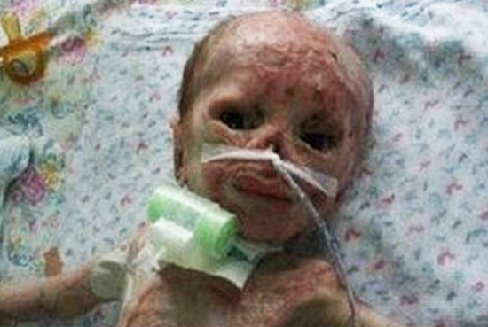سوختن نوزاد 3 روزه در دستگاه فتوتراپی بیمارستان/ والدین سنگدل نوزاد بی‌گناه را در بیمارستان رها کردند