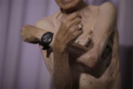 زخمهای هفتاد ساله بمباران ناگازاکی بر بدن یک مرد+تصاویر