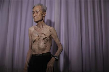 زخمهای هفتاد ساله بمباران ناگازاکی بر بدن یک مرد+تصاویر