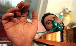 درمان زخم بستر جانبازان با سلول‌های بنیادین در مشهد