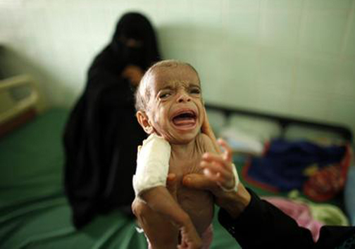 تصاویر دلخراش از کودکان قحطی‌زده یمن