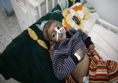 تصاویر دلخراش از کودکان قحطی‌زده یمن