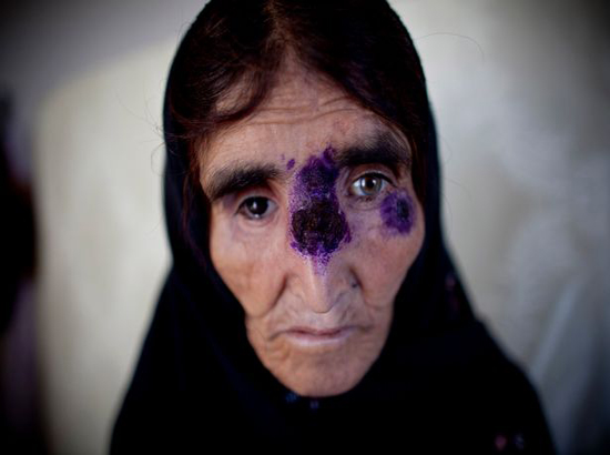 شیوع بیماری مرگبار ترسناک میان داعشی ها + تصاویر