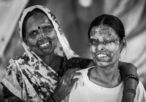 زندگی  قربانیان اسیدپاشی در هند + تصاویر