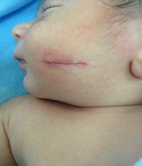 سزارین باز هم حادثه آفرید/ این بار صورت نوزاد هدف تیغ جراحی شد
