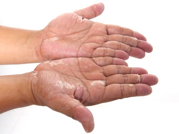 5 درمان خانگی فوق العاده برای اگزمای پوستی