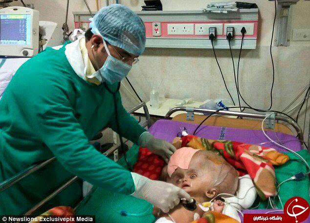 جراحی نوزادی با بزرگترین سر دنیا+ تصاویر