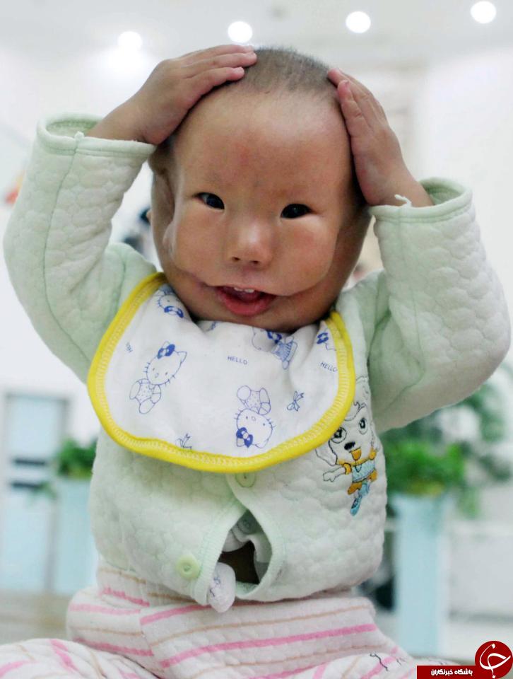 کودک عجیبی که به کودک ماسک دار معروف شده است / تصاویر