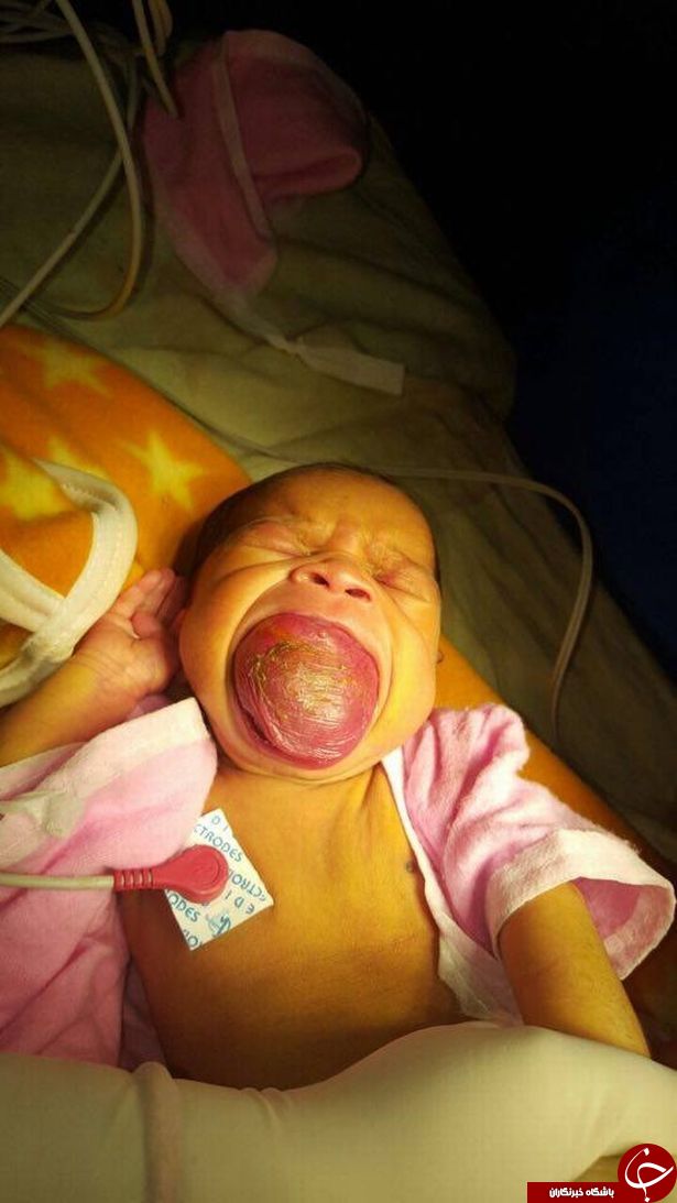تولد نوزادی با زبان بسیار بزرگ/ تصاویر