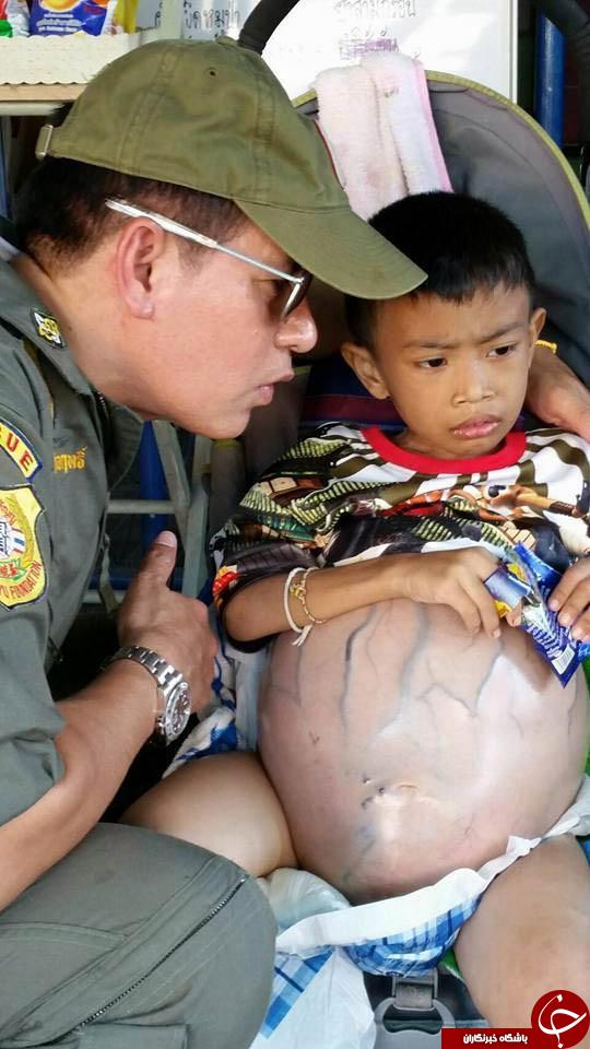 تومور بزرگ، کودک تایلندی را زمین گیر کرد + تصاویر /ویژه جمعه