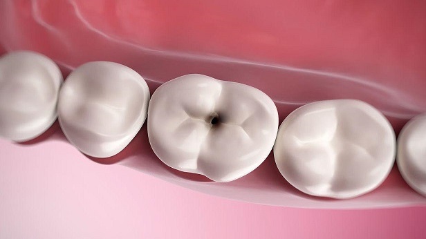 80 درصد فعالیت دانشکده‌های دندانپزشکی برای درمان پوسیدگی دندان‌ها ست