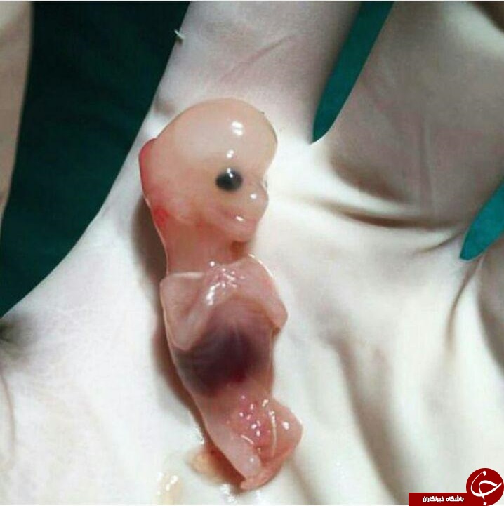 تصویر یک جنین 7 هفته ای که همه را شوکه کرد+ عکس