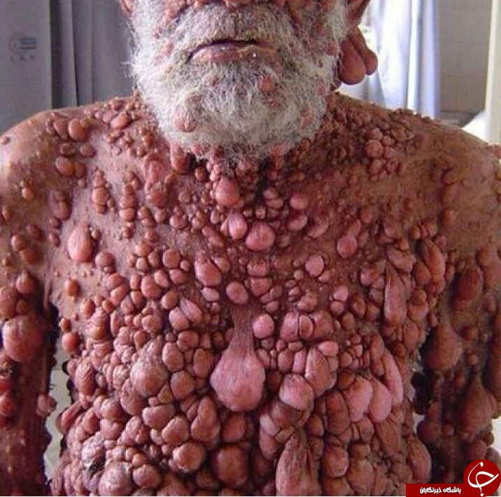 مردی که تمام بدنش تومور دارد+عکس