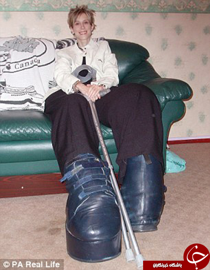 زنی که مجبور شد به خاطر بزرگ بودن پایش، آن را قطع کند + تصاویر
