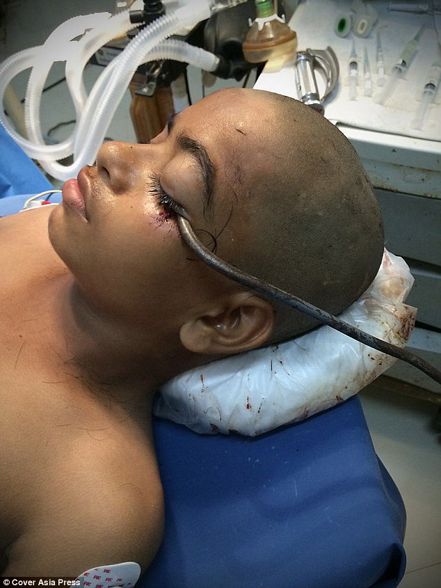 نجات معجزه‌آسای پسربچۀ هندی بعد از فرو رفتن قلاب قصابی در چشمش +تصاویر