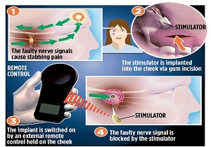 درمان سردردهای خوشه‌ای با نصب تراشه الکترونیکی در بدن