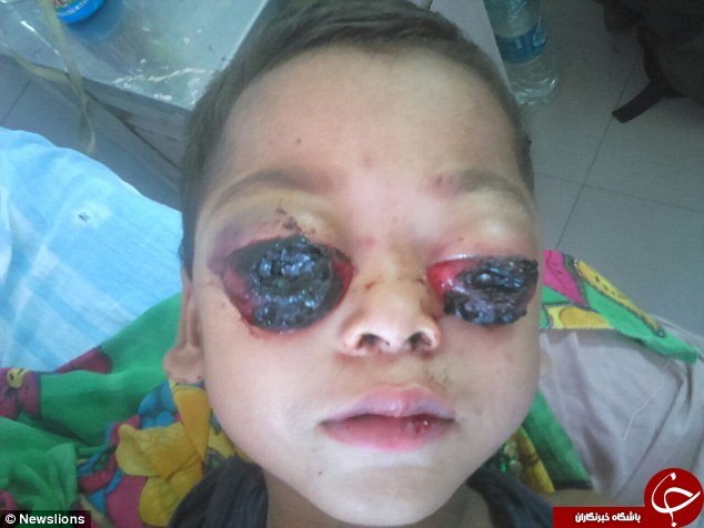 بیماری وحشتناک پسربچه هندی؛ چشمان این کودک از حدقه بیرون زده است +تصاویر