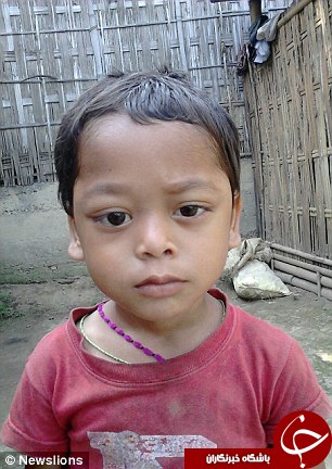 بیماری وحشتناک پسربچه هندی؛ چشمان این کودک از حدقه بیرون زده است +تصاویر