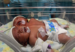 تولد نادر یک نوزاد 2 سر در اندونزی+ فیلم و تصاویر 