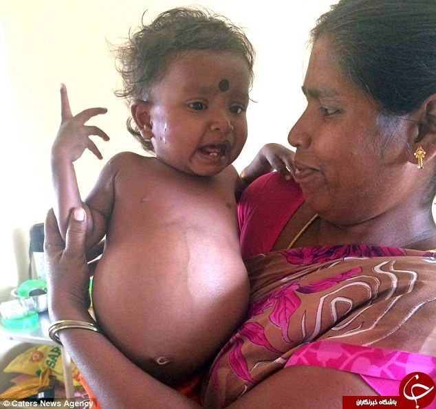 نوزاد دختر هنگام تولد، دوقلو باردار بود+تصاویر