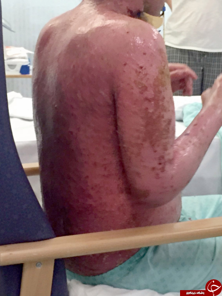 وحشتناک‌ترین آلرژی جهان؛ این بیمار زنده زنده سوخت+ تصاویر (18+)