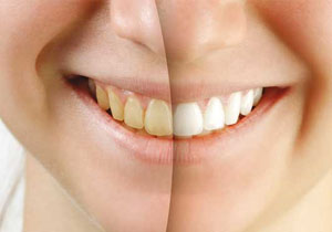 آیا سفید کردن دندان‌ها روش قابل اعتمادی است؟