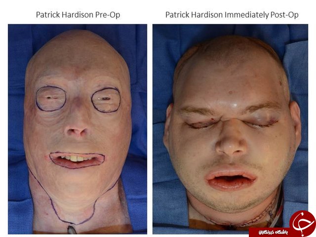 معجزه پزشکی متخصص جراحی زیبایی عکس جراحی زیبایی پیوند صورت پاتریک هاردیسون patrick hardison