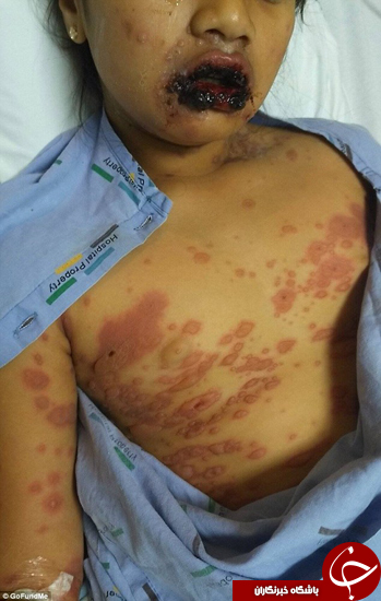 بیماری این کودک 9 ساله در حال خوردن پوست او است +تصاویر