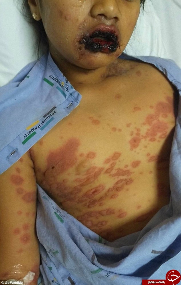 بیماری نادری که کودک 9 سال را زامبی کرد+تصاویر