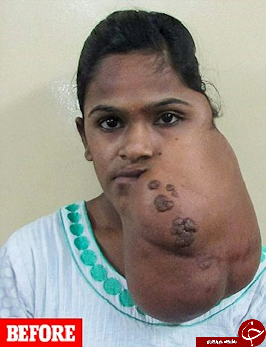 خروج تومور ۲.۸ کیلویی از صورت دختر هندی +تصاویر
