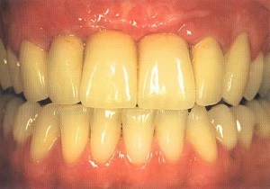 نتیجه تصویری برای دندان زرد