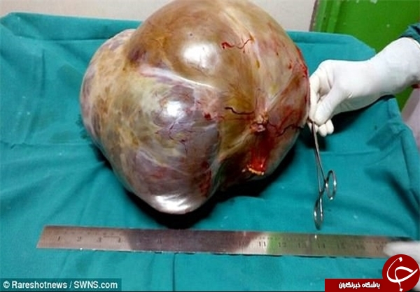 خارج کردن تومور 11 کیلویی از شکم پیرزن 70 ساله!+ تصاویر