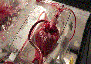 مهم‌ترین روش درمانی جایگزین پیوند قلب چیست؟