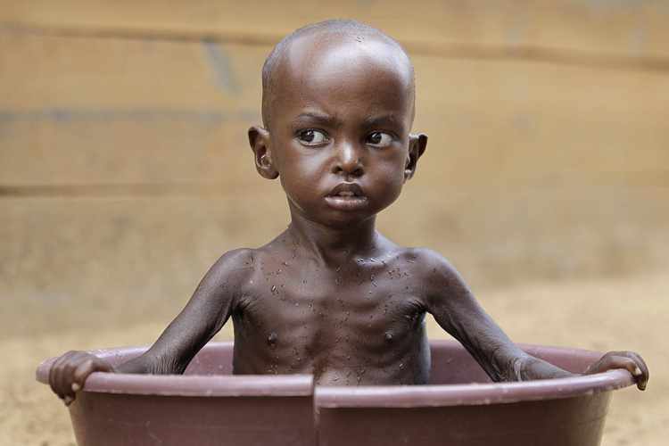 سوء تغذیه‌ای که جهان گرسنه را می‌بلعد