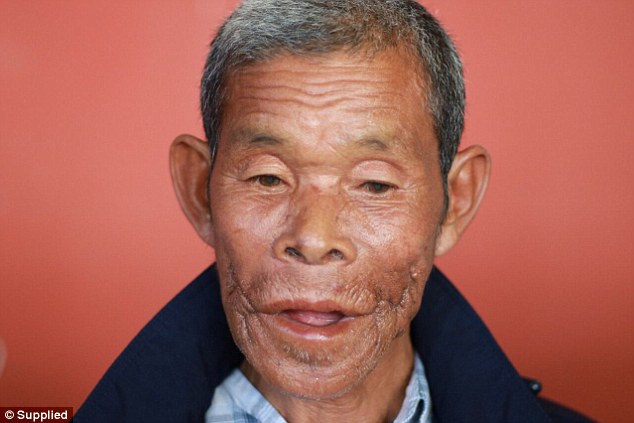 خارج کردن ترسناکترین تومور ازصورت یک مرد کامبوجی +تصاویر+۱۸