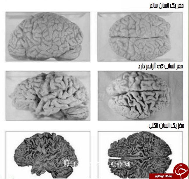 مقایسه مغز انسان عادی با یک انسان الکلی +عکس