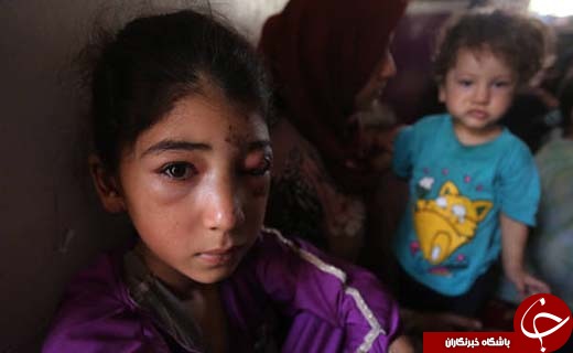 تصاویری تکان دهنده از زخم جنگ بر سر و صورت کودکان تلعفر