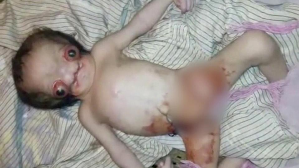 تولد نوزاد عجیب الخلقه شبیه به موجودات فضایی در هند