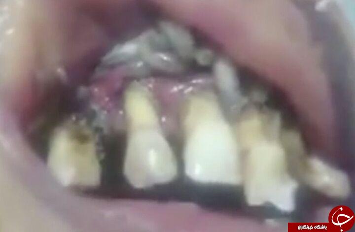 مشمئزترین صحنه ای که یک دندانپزشک با آن روبرو شد + فیلم