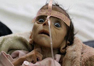 مرگ تدریجی میلیون‌ کودک یمنی به دلیل جلوگیری عربستان از کمک رسانی + فیلم