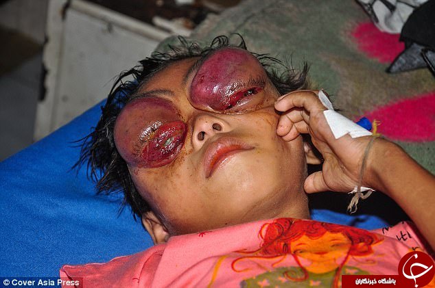 عفونت چشمان دختر بچه هندی را غرق در خون کرده است+ فیلم