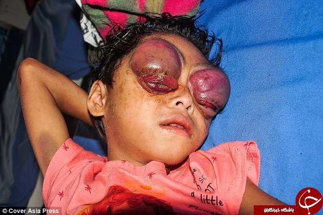 عفونت چشمان دختر بچه هندی را غرق در خون کرده است+ فیلم
