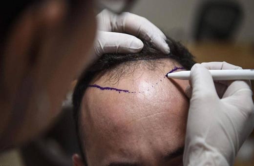 حادثة حيرت العلماء.. وفاة شخص في عملية زراعة شعر