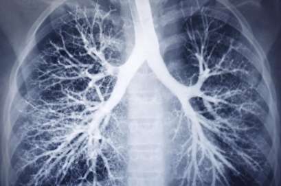 Cancer drug extends life expectancy in clinical trials for patients with lung cancer