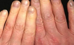 علل سرد شدن دست‌ها چیست؟