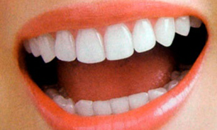 جراحی های دهان و دندان در مبتلایان به پلاکت پایین جایز نیست